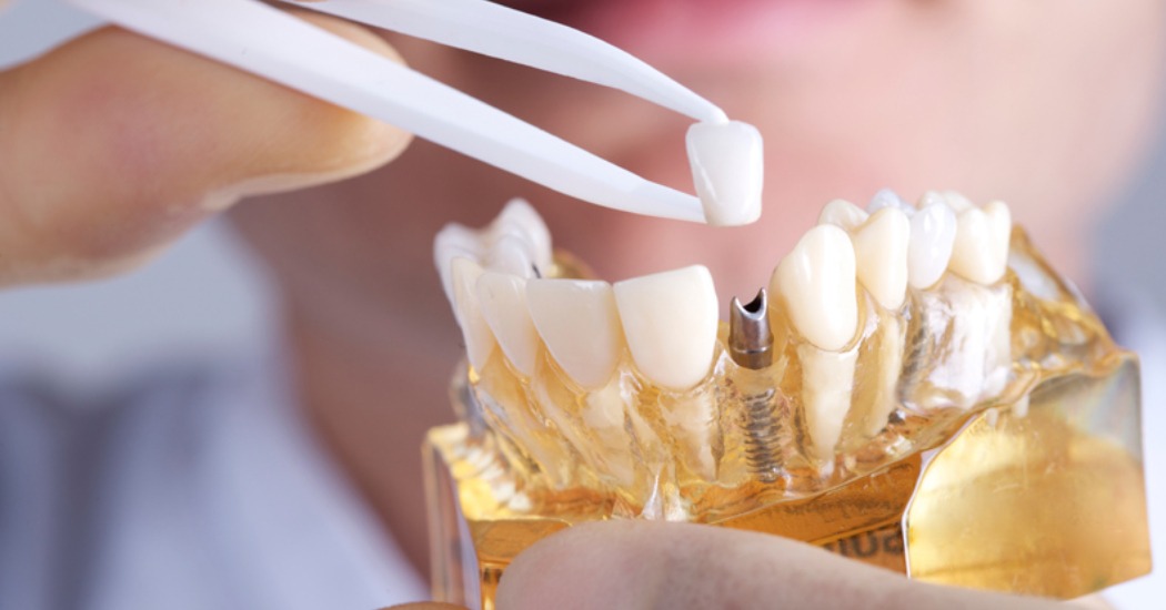 Why Patients Trust Professional Root Canal in Richmond Dental Care